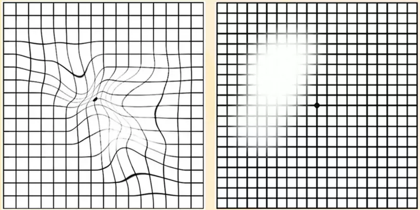 황반변성 환자 시야 예시