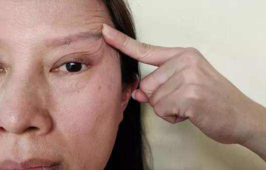 안검하수 이미지