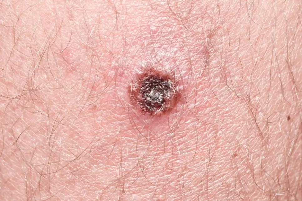 쯔쯔가무시증의 증상