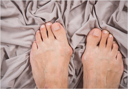 엄지발가락 변형, 무지외반증